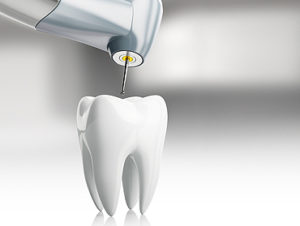 terapia-endodontica
