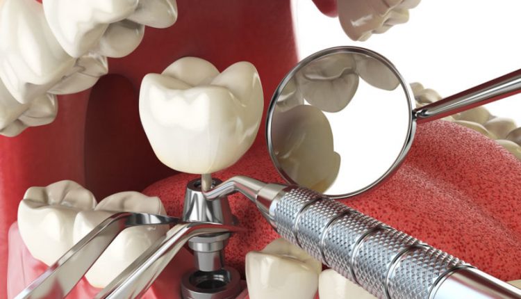 dental-implant-concept-825×619